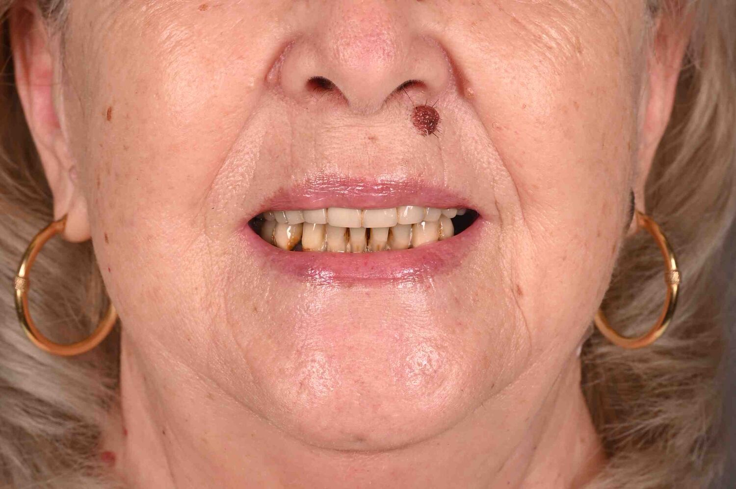 Pacient Clinica Dr. Alin Odor - Rezultat Implantologie